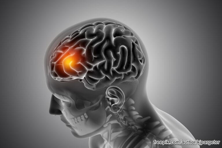 Moždani udar – uzroci, simptomi i oporavak prirodnim putem