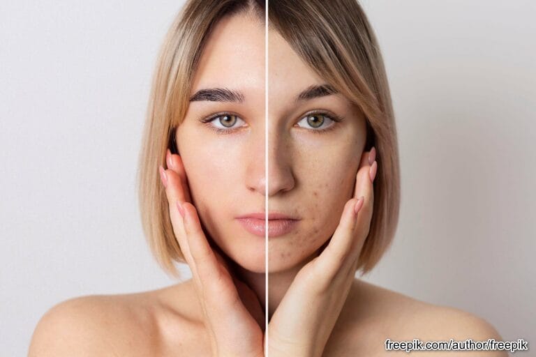 Akne i kožni problemi kod tinejdžera Akne i kožni problemi kod tinejdžera